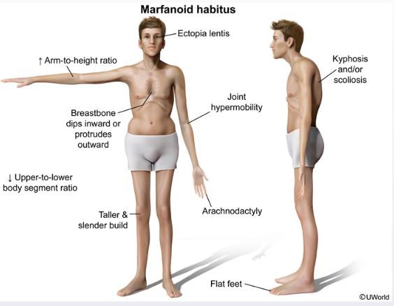 síndrome de marfan